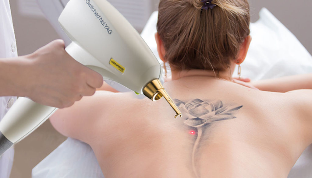 Lumenis М22 лазерное удаление татуировок и татуажа