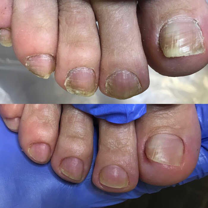 Грибок ногтей на ногах, чем лечить?