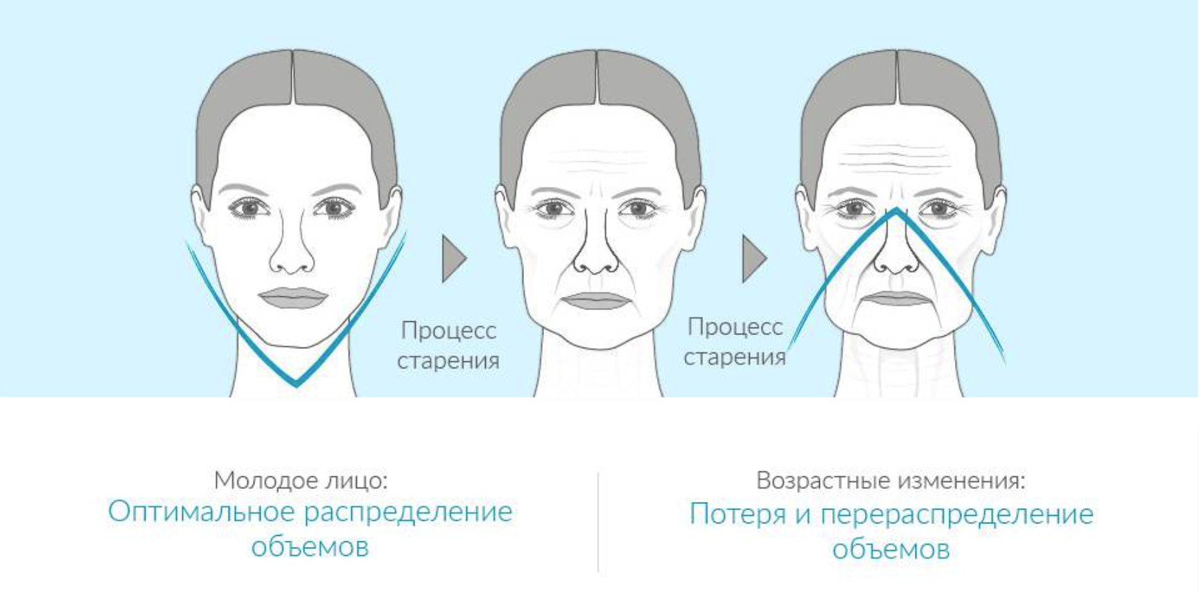 Объем лицу. Моделирование овала лица. Радиесс схема введения. Контурное моделирование лица. Моделирование лица Радиессом.